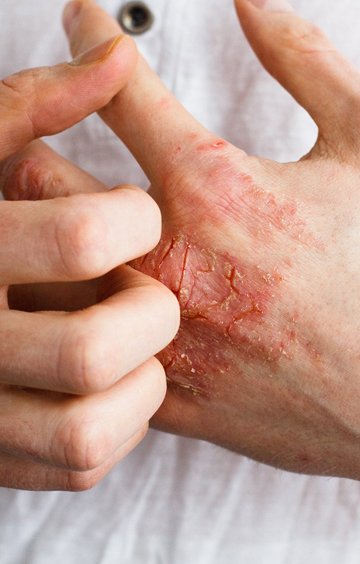 Eczema