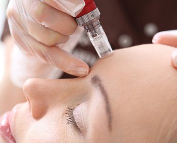 Micro needling