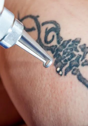 Tattoo Removal: Is laser tattoo removal painful | Clearskin, Pune